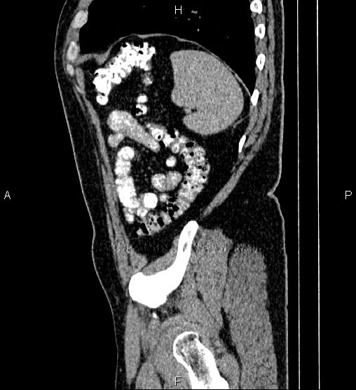 Acute appendicitis (Radiopaedia 84780-100240 Sagittal C+ portal venous phase 91).jpg