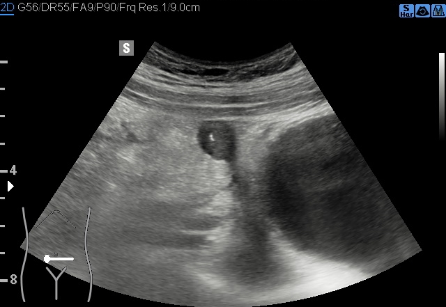 File:Acute appendicitis (Radiopaedia 85193-100745 B 118).jpg