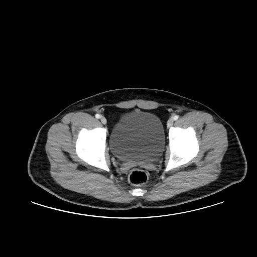 File:Acute appendicitis and COVID 19 pneumonia (Radiopaedia 76604-88380 Axial C+ portal venous phase 78).jpg