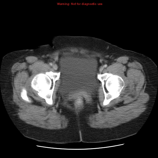 Acute appendicitis complicated by ovarian vein thrombophlebitis (Radiopaedia 16172-15851 Axial C+ portal venous phase 83).jpg