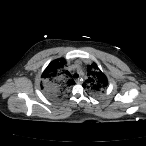 Acute aspiration pneumonitis (Radiopaedia 33605-34703 Axial non-contrast 28).jpg
