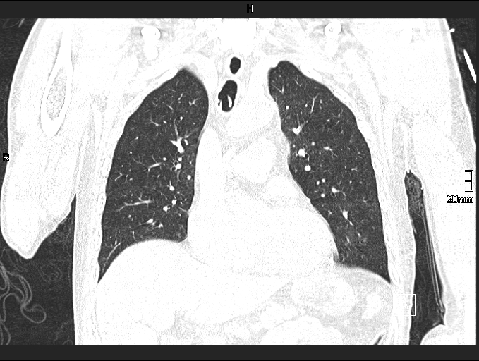 File:Acute aspiration pneumonitis (Radiopaedia 55642-62166 Coronal lung window 40).jpg