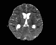 File:Acute cerebellar ataxia (Radiopaedia 61487-69446 Axial ADC 11).jpg