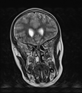 File:Acute cerebellar ataxia (Radiopaedia 61487-69446 Coronal T2 2).jpg
