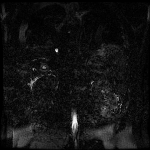 Acute cholecystitis and biliary hamartomas (Radiopaedia 86231-102240 E 5).jpg