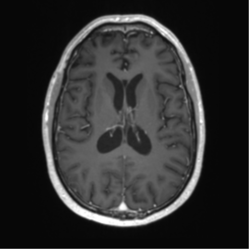 Acute disseminated encephalomyelitis (ADEM) (Radiopaedia 65319-74350 Axial T1 C+ 36).png