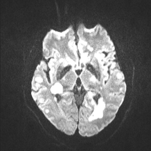 Acute disseminated encephalomyelitis (Radiopaedia 37253-39033 Axial DWI 41).jpg