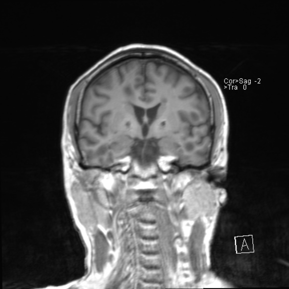 File:Acute disseminated encephalomyelitis (Radiopaedia 37253-39033 Coronal T1 13).jpg