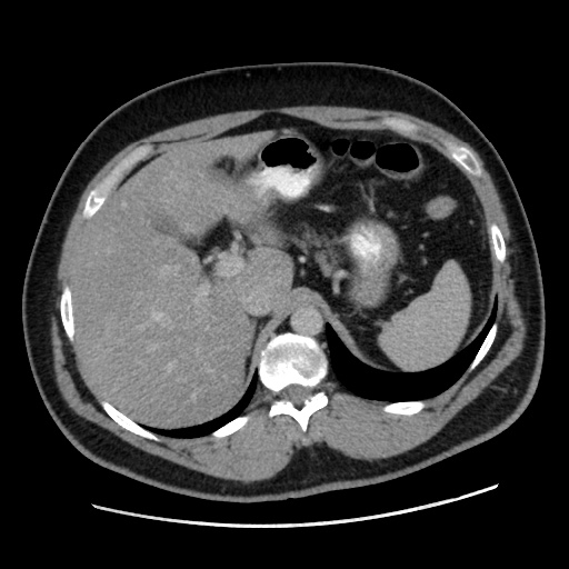 Acute diverticulitis with localized perforation (Radiopaedia 41296-44113 Axial C+ portal venous phase 23).jpg