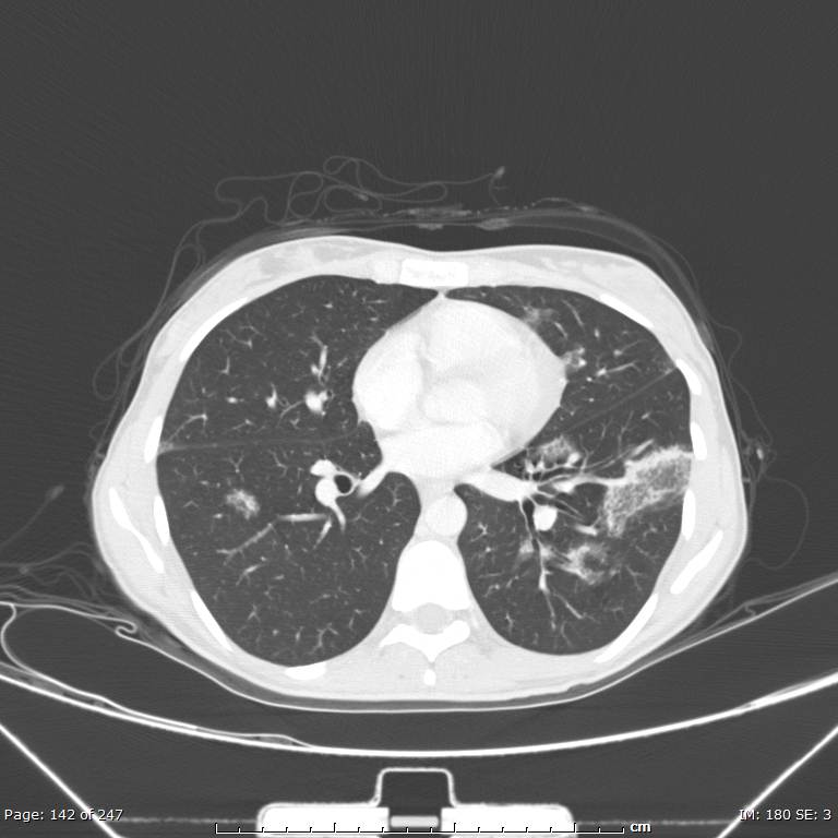 Acute eosinophilic pneumonia (Radiopaedia 48211-53073 Axial lung window 51).jpg