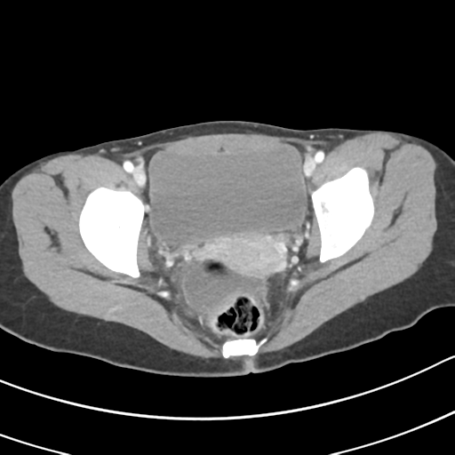 Acute gangrenous appendicitis with perforation (Radiopaedia 40152-42662 Axial C+ portal venous phase 68).png