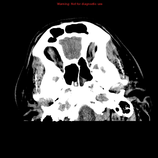 File:Acute hemorrhagic leukoencephalitis (Radiopaedia 14076-72275 Axial non-contrast 3).jpg