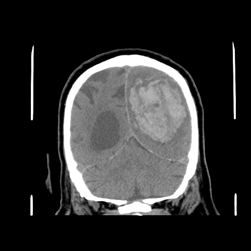 Acute hemorrhagic stroke (Radiopaedia 17507-17223 Coronal non-contrast 41).jpg