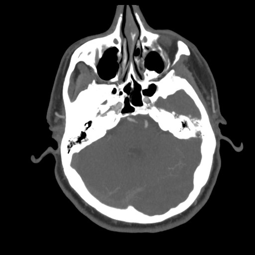 File:Acute internal carotid artery dissection (Radiopaedia 53541-59630 D 22).jpg