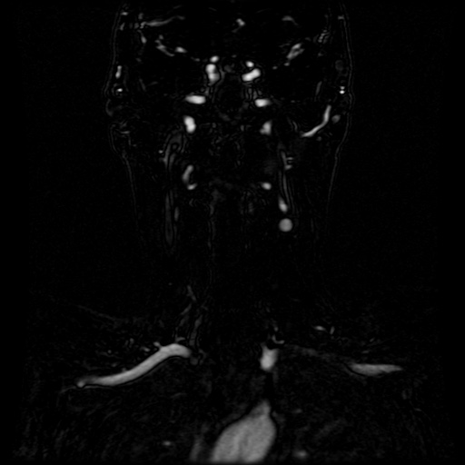 Acute internal carotid artery dissection (Radiopaedia 53541-59632 Coronal MRA 43).jpg