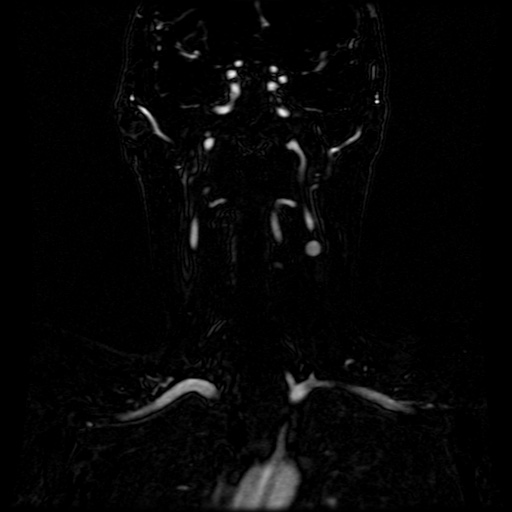Acute internal carotid artery dissection (Radiopaedia 53541-59632 Coronal MRA 46).jpg