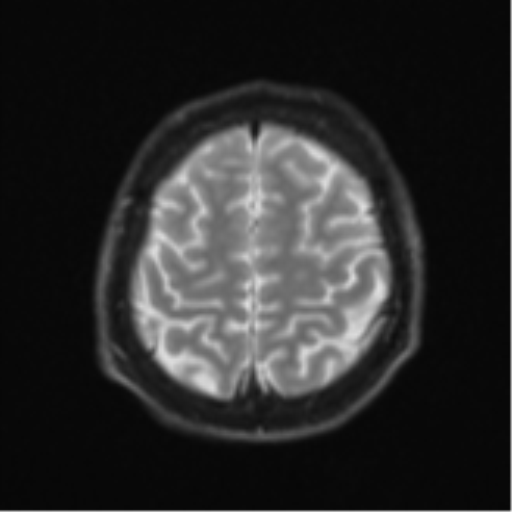 Acute left middle cerebral artery territory infarct with clot retrieval (Radiopaedia 47732-52433 Axial DWI 25).png