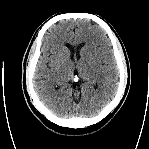Acute left middle cerebral artery territory ischemic stroke (Radiopaedia 35688-37223 Axial non-contrast 38).png