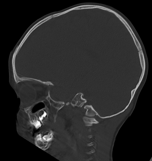 Acute mastoiditis (Radiopaedia 82678-96881 Sagittal bone window 42).jpg