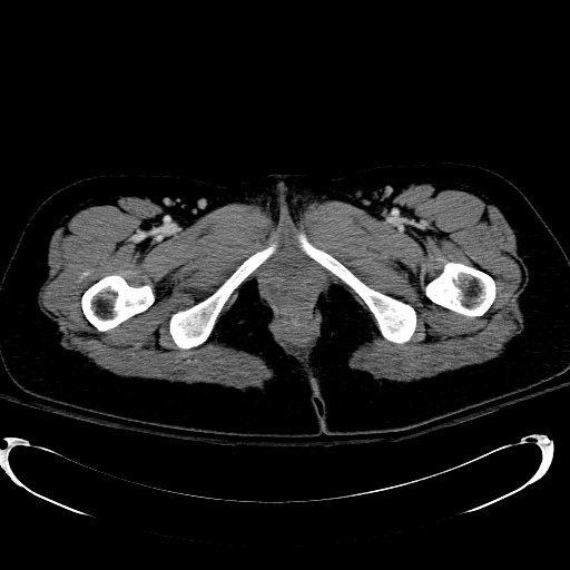 File:Acute myocardial infarction in CT (Radiopaedia 39947-42415 Axial C+ portal venous phase 146).jpg