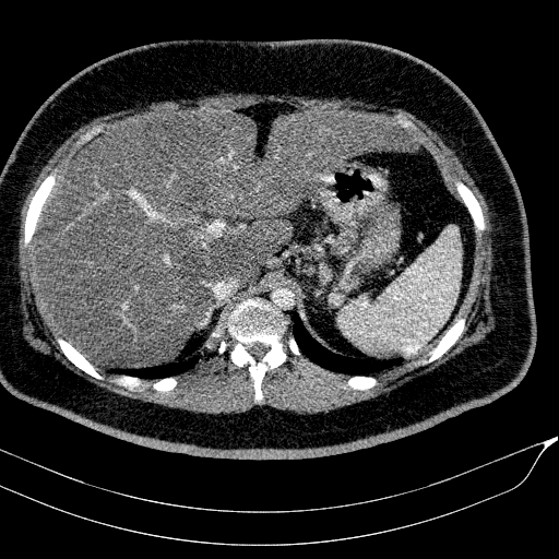 File:Acute on chronic pancreatitis (Radiopaedia 80902-94423 Axial C+ portal venous phase 39).jpg