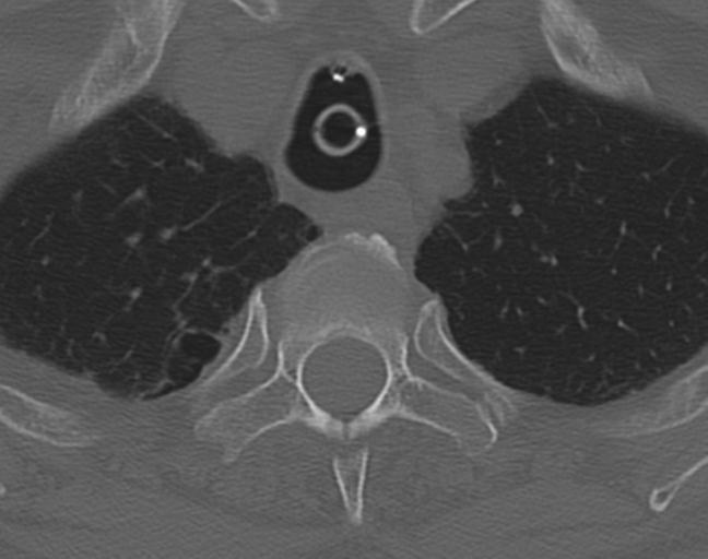 Acute on chronic subdural hematoma and thoracic vertebral injury in a multitrauma patient (Radiopaedia 31698-32619 Axial bone window 64).jpg