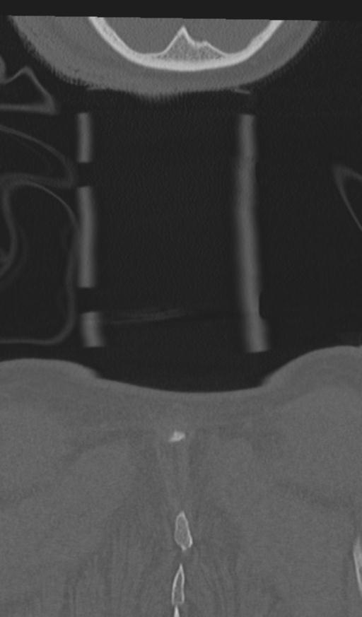 Acute on chronic subdural hematoma and thoracic vertebral injury in a multitrauma patient (Radiopaedia 31698-32619 Coronal bone window 78).jpg