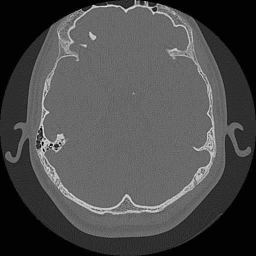 Acute otomastoiditis and Bezold abscess (Radiopaedia 88184-104786 Axial bone window 49).jpg
