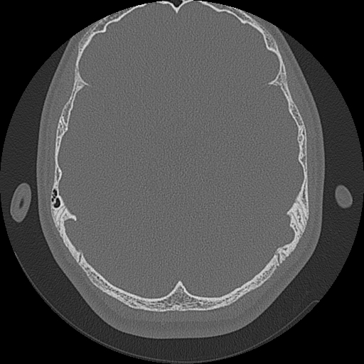 Acute otomastoiditis and Bezold abscess (Radiopaedia 88184-104786 Axial bone window 54).jpg