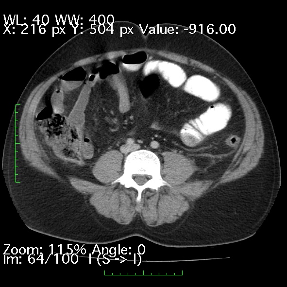 File:Acute pancreatitis (Radiopaedia 34043-35276 Axial C+ portal venous phase 64).jpg