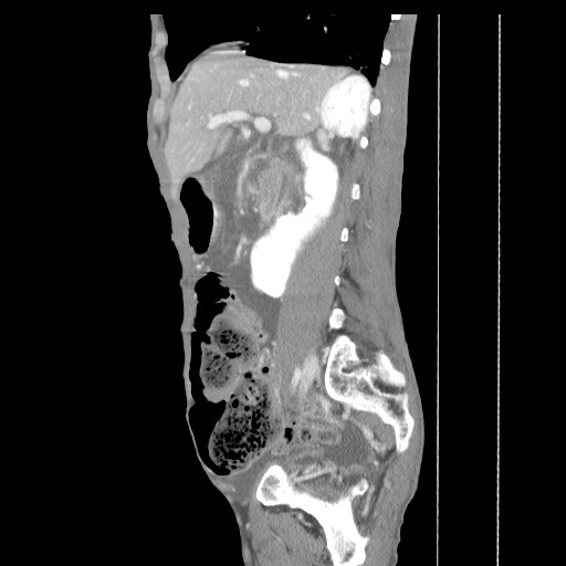 File:Acute pancreatitis (Radiopaedia 50213-55558 Sagittal C+ portal venous phase 17).jpg