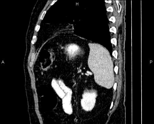Acute pancreatitis (Radiopaedia 85146-100701 Sagittal C+ portal venous phase 78).jpg