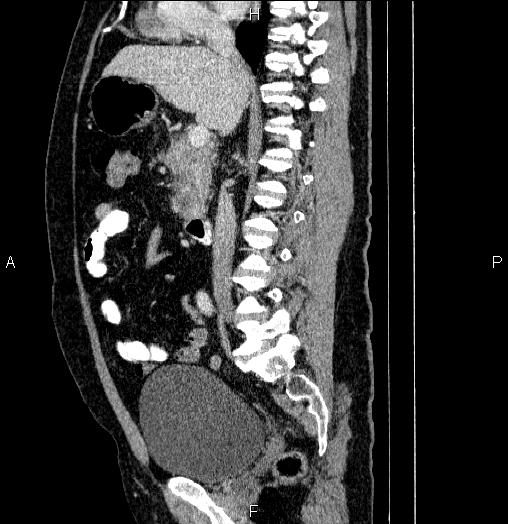 Acute pancreatitis (Radiopaedia 85390-101010 Sagittal C+ portal venous phase 45).jpg
