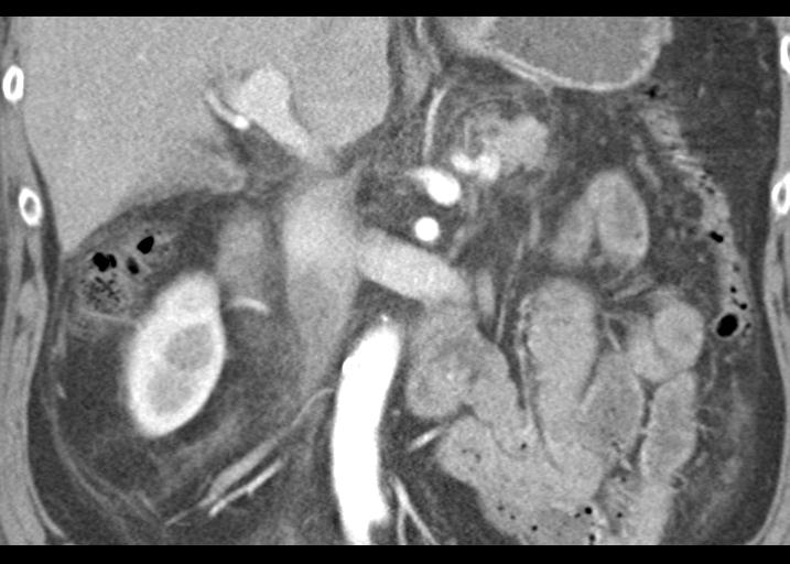 Acute pancreatitis and walled-off necrosis (Radiopaedia 29888-30403 Coronal C+ portal venous phase 30).jpg