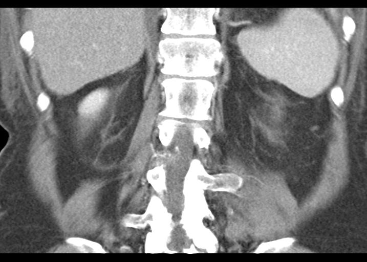 Acute pancreatitis and walled-off necrosis (Radiopaedia 29888-30403 Coronal C+ portal venous phase 44).jpg