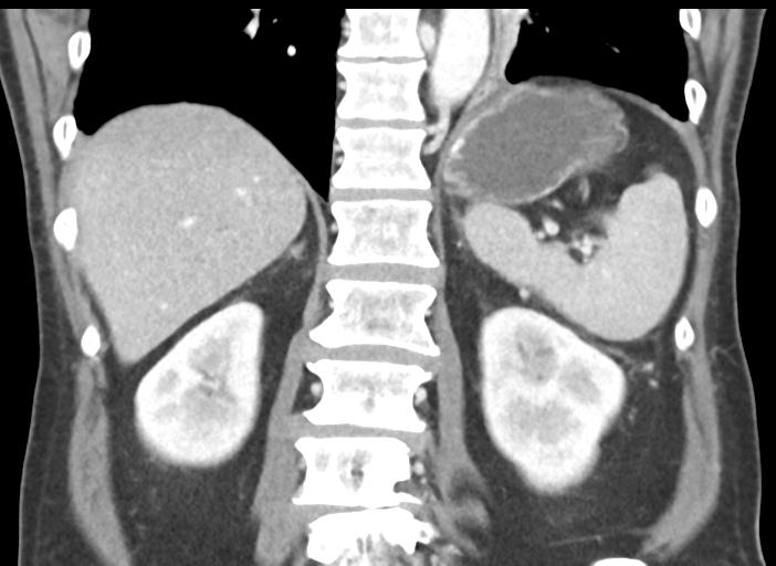 Acute pancreatitis and walled-off necrosis (Radiopaedia 29888-30404 Coronal C+ portal venous phase 38).jpg