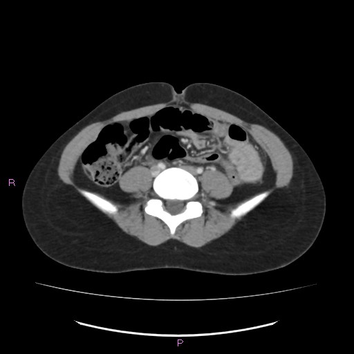 Acute pancreatitis secondary to stone at minor papilla and pancreatic divisum (Radiopaedia 76570-88333 Axial C+ portal venous phase 49).jpg