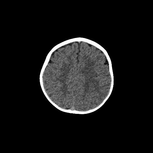 Acute phase of hemiconvulsion-hemiplegia epilepsy syndrome (Radiopaedia 29309-29744 Axial non-contrast 15).jpg