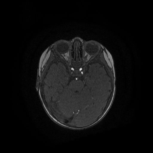 Acute phase of hemiconvulsion-hemiplegia epilepsy syndrome (Radiopaedia 29309-29745 Axial TOF angiography 96).jpg