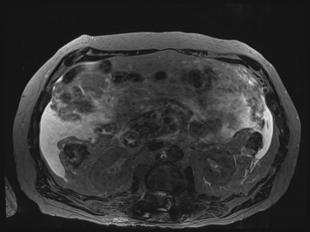 Acute portal vein thrombosis (Radiopaedia 73198-83925 Axial Heavily T2 thin cuts 52).jpg