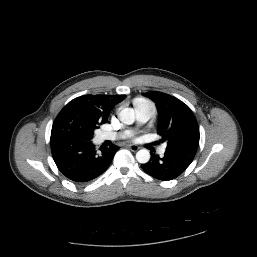 Acute segmental pulmonary emboli and pulmonary infarction (Radiopaedia 62264-70444 Axial C+ CTPA 55).jpg