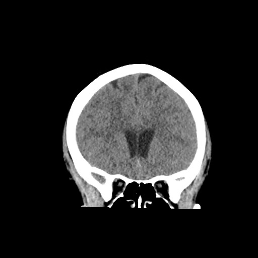Acute subarachnoid hemorrhage and accessory anterior cerebral artery (Radiopaedia 69231-79008 Coronal non-contrast 26).jpg