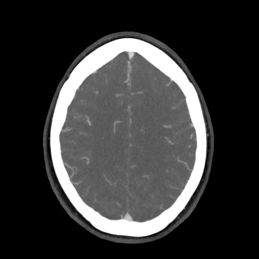 Acute subarachnoid hemorrhage and accessory anterior cerebral artery (Radiopaedia 69231-79009 D 51).jpg