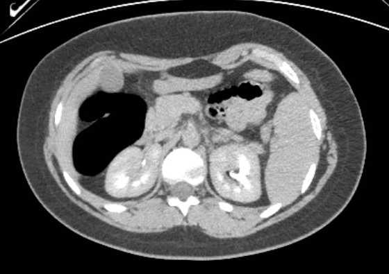 Acute unilateral nonhemorrhagic adrenal infarction (Radiopaedia 67560-76957 Axial renal excretory phase 52).jpg