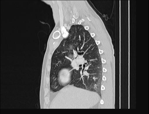 File:Addison disease (Radiopaedia 49318-54412 Sagittal lung window 41).jpg