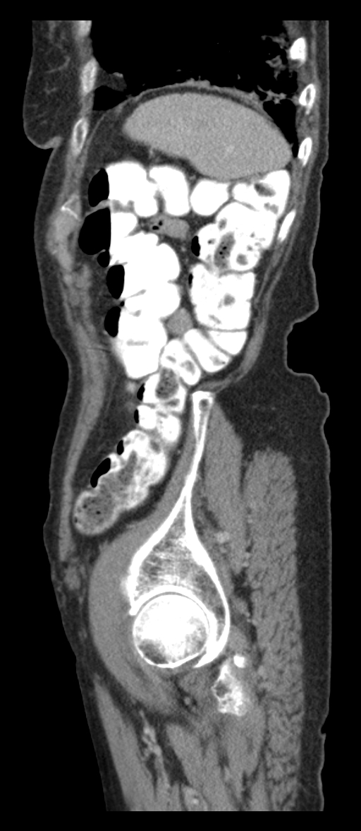 Adenocarcinoma of cecum (Radiopaedia 59222-66549 Sagittal C+ portal venous phase 8).jpg