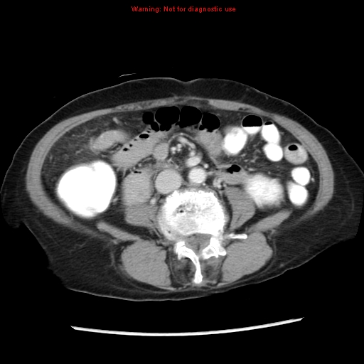 File:Adenocarcinoma of the colon (Radiopaedia 8191-9039 Axial liver window 42).jpg