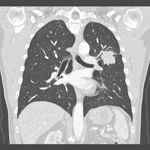 Adenocarcinoma of the lung (Radiopaedia 59871-67325 Coronal lung window 35).jpg