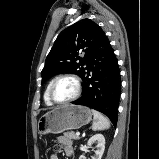 Adenocarcinoma of the lung (Radiopaedia 59871-67325 Sagittal C+ arterial phase 74).jpg