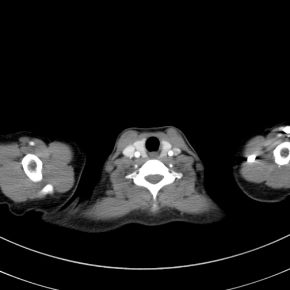 Adenocystic carcinoma of the trachea (Radiopaedia 47677-52525 Axial C+ arterial phase 24).jpg
